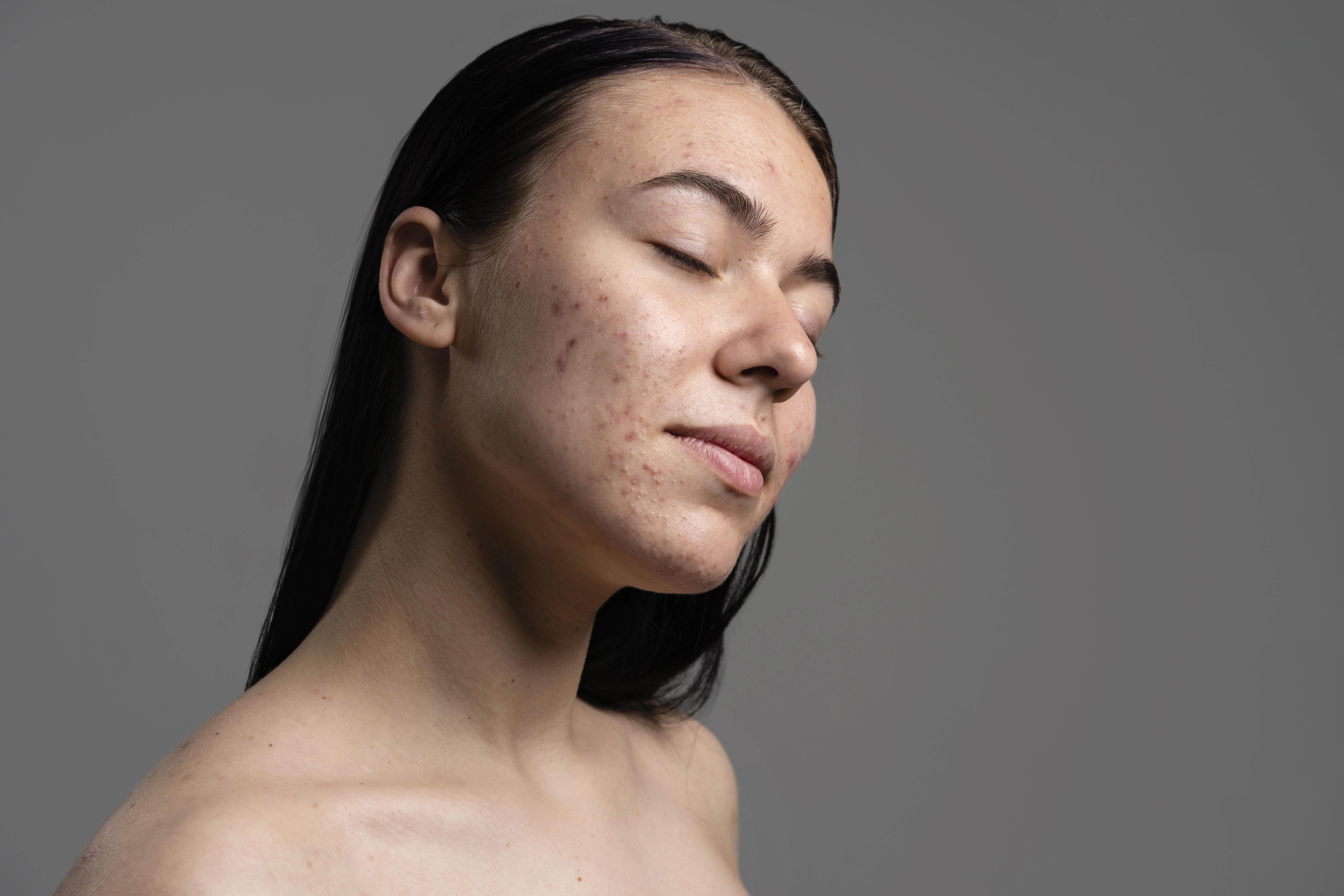portrait-beautiful-young-woman-with-acne